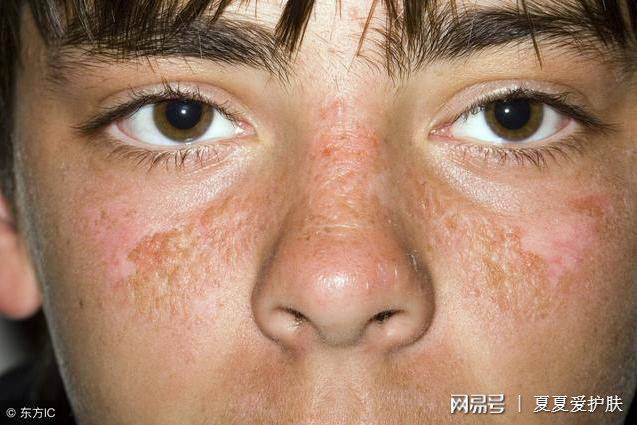 雀斑|色素斑点如何高效解决？圣秋波给你答案