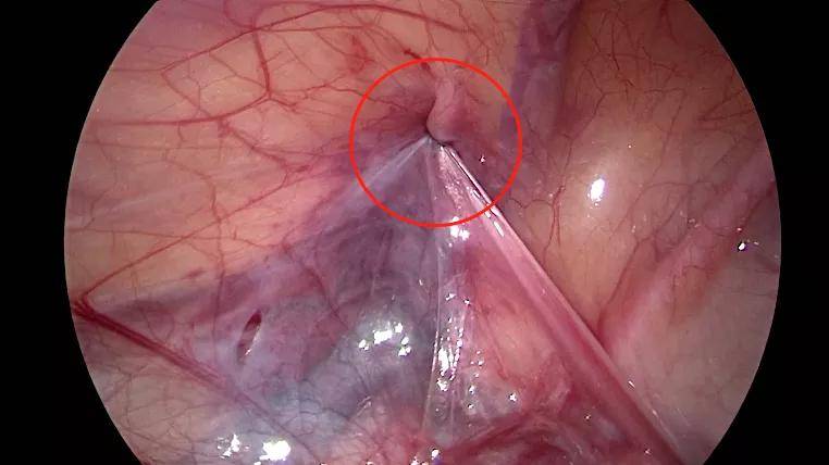 时间|小儿疝气手术，做了24小时就可出院？