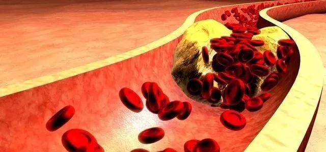心脑血管|动脉硬化危害大吗?什么情况下要吃药?应如何防治?这里全讲全了!