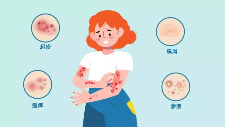 特应性皮炎的微生态疗法:恢复免疫平衡,改善过敏体质