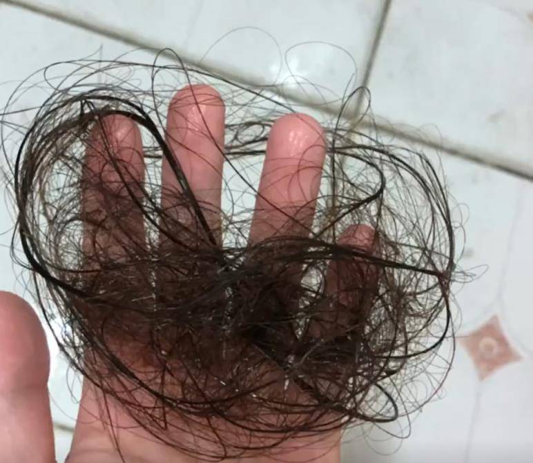 头发少如何增加发量摆脱掉发不是梦