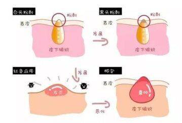 黑头|佰花方：脸上老是长闭合性粉刺，使用哪些护肤品可以去除？