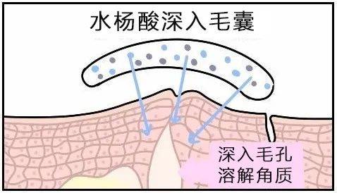 黑头|测后严选丨同样是刷酸，为何别人换脸，而你烂脸？