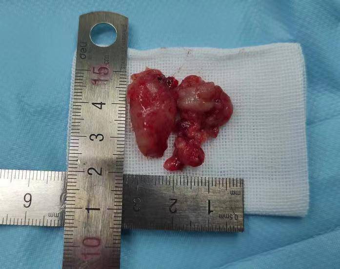 跨越千里来汉求医爹爹顺利摘除眼眶肿瘤
