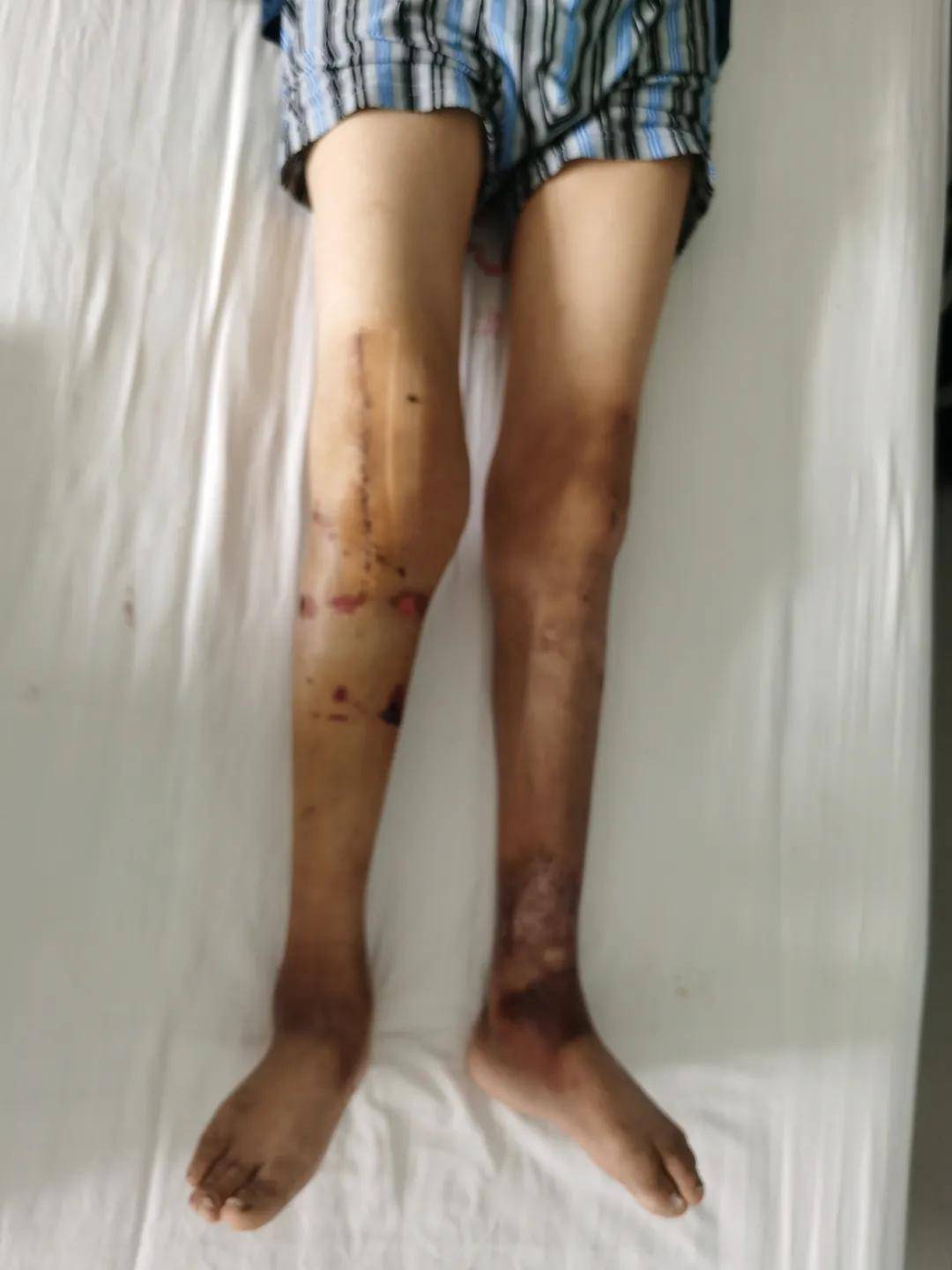 手术|西安市红会医院阎良院区双膝关节置换术圆了甘肃患者“行走梦”