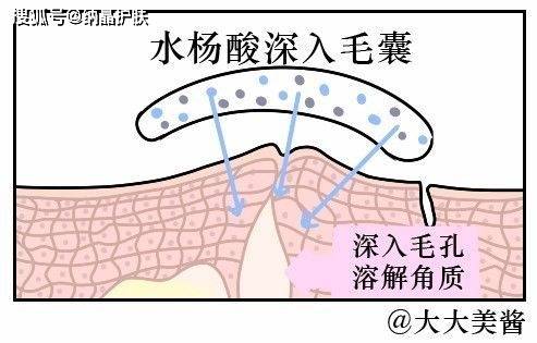 进行|夏日烂脸，满是痘印，新手小白在家可以刷酸焕肤吗？
