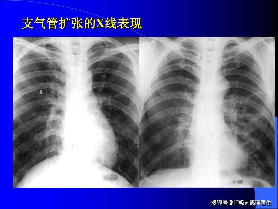 治疗|老慢支平常该如何护理？