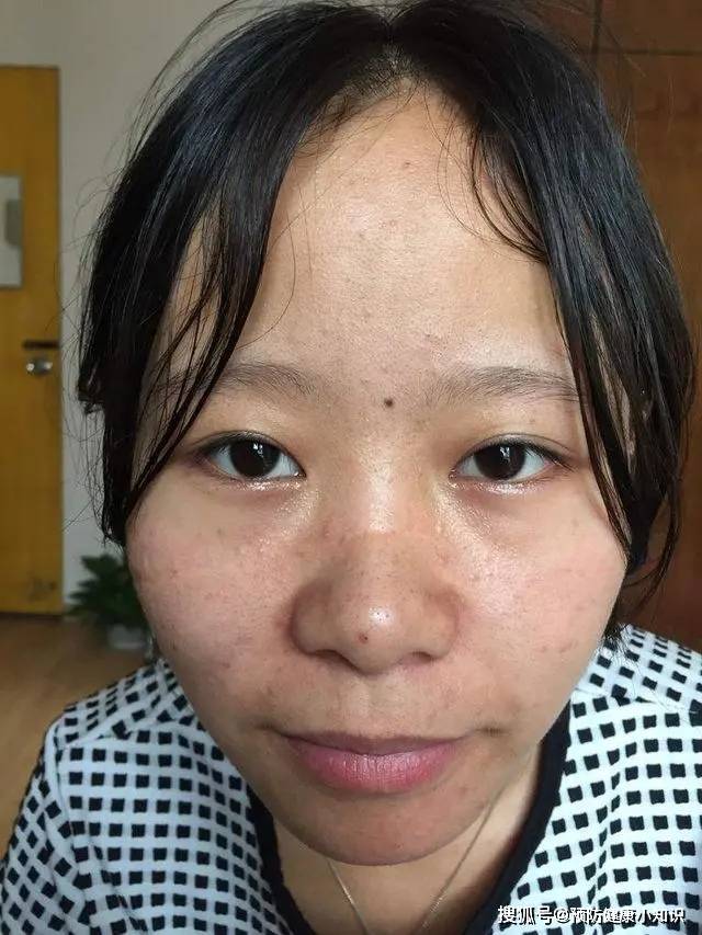 气血|脸上有3个变化,可能肝脏积毒太深,占一个,最好去查查肝功!