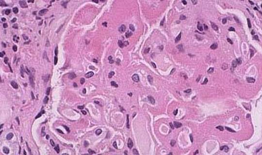 症状|狼疮性肾炎是什么？有什么症状？看了您就懂了！