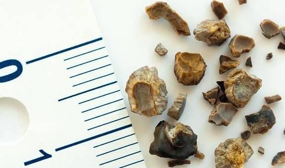 诊断|生活习惯都很规律,为什么会得肾结石。肾结石是身体内有石头吗?