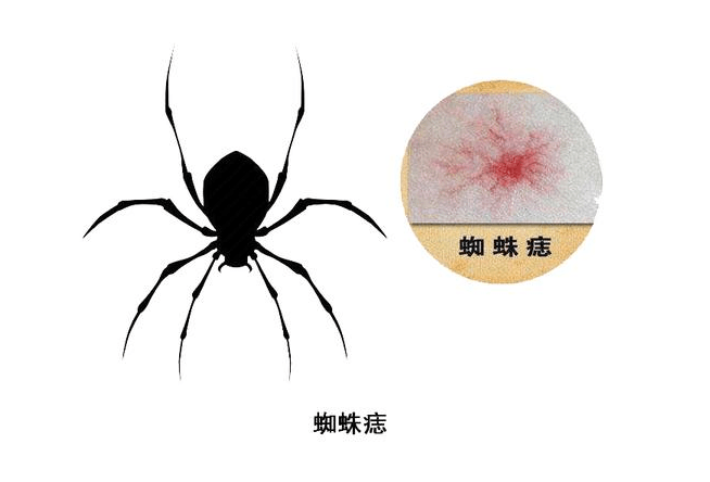 能力|体内有癌，皮肤告知？身体3处皮肤异常，警惕肝癌或正在靠近！