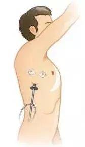 胸膜|“神探”内科胸腔镜