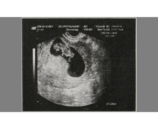 怀孕圆形孕囊图片图片