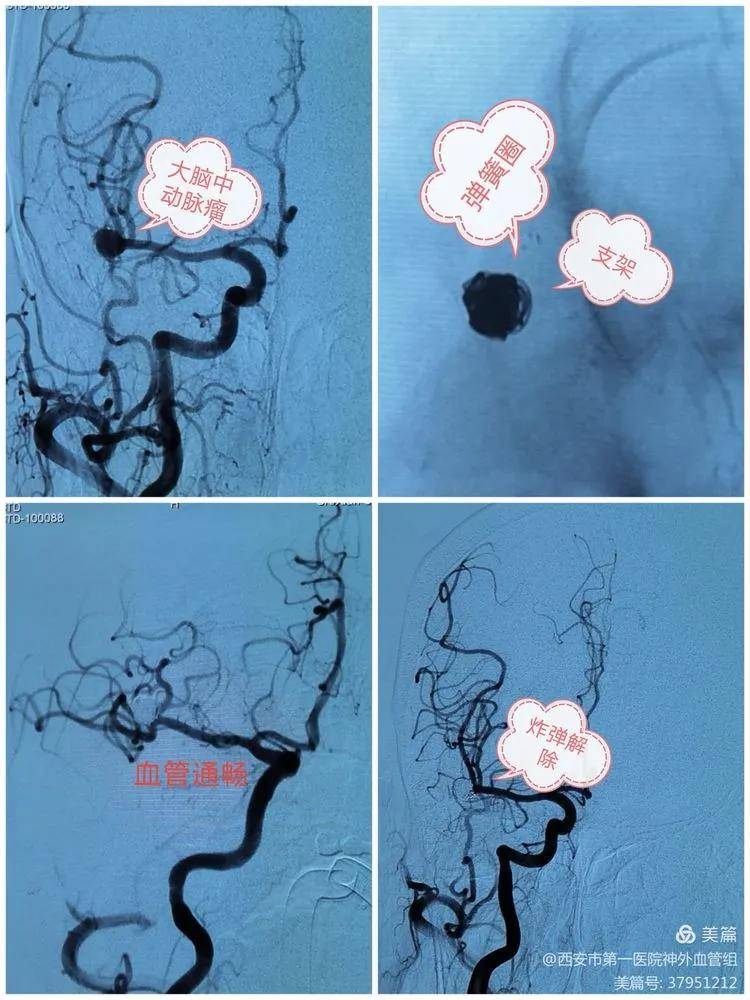 头颅|【医院动态】西安一院神外血管组介入病例系列15——7月“拆弹”“修路”记