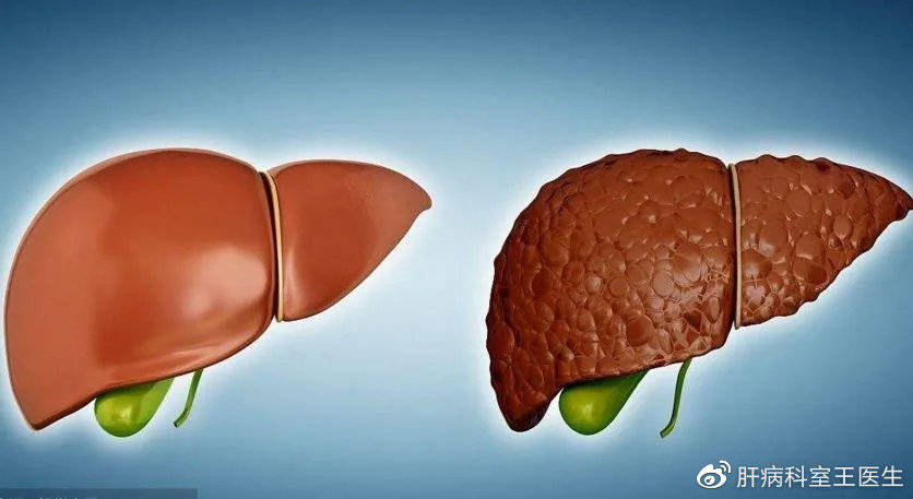 脾脏|肝硬化的5个早期症状