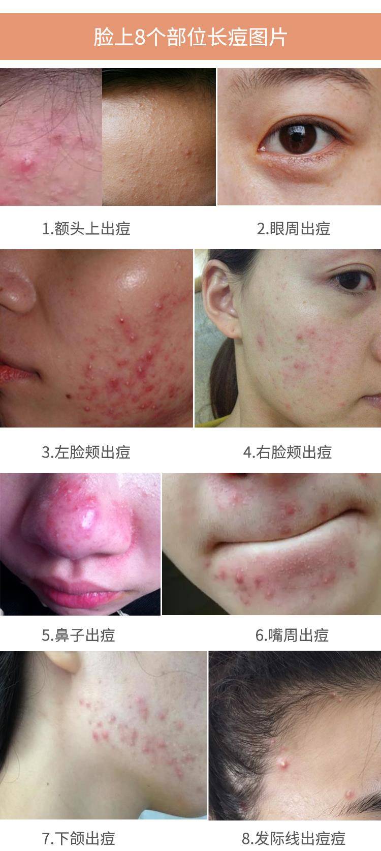 因为|脸上长痘痘是因为什么原因引起的？怎么才能把脸洗干净？（图片）