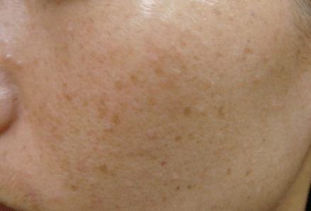 阑尾炎症状不明显需要手术吗 91ff4d6a77d84657bd580074c64c952a.png