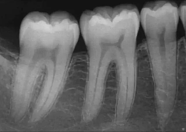 看牙為什麼要拍x光片?_牙齒