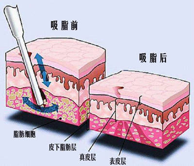 进行|李朕（李春财）：抽脂的风险有哪些