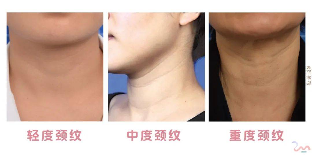 分子|嗨体1.5ml和2.5ml之间的区别?!