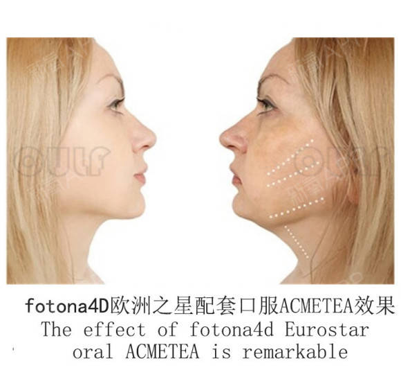 治疗|欧洲之星fotona4d初体验，我被安利的变美好物