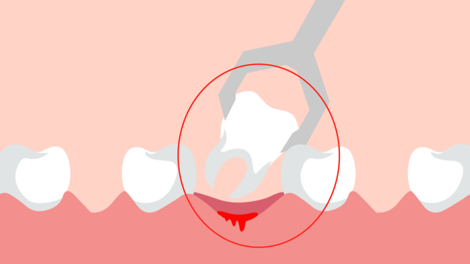 风险|5岁孩子拔牙后脑死亡，拔牙前有注意事项，不仅是张大嘴巴