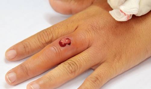 什么|误认为皮肤过敏,结果查出肝癌!提醒:皮肤4种异常或是肝癌前兆