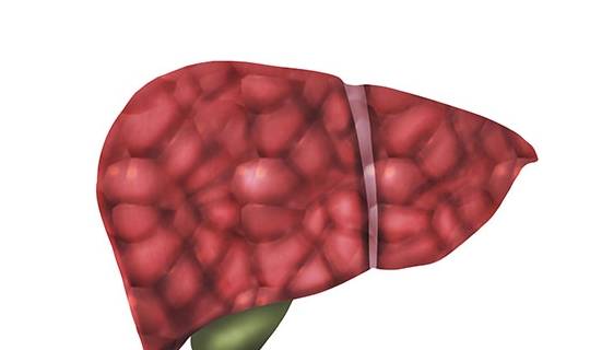 治疗|得了肝硬化别灰心，并非不可逆转，怎么做能让硬了的肝脏软回去？