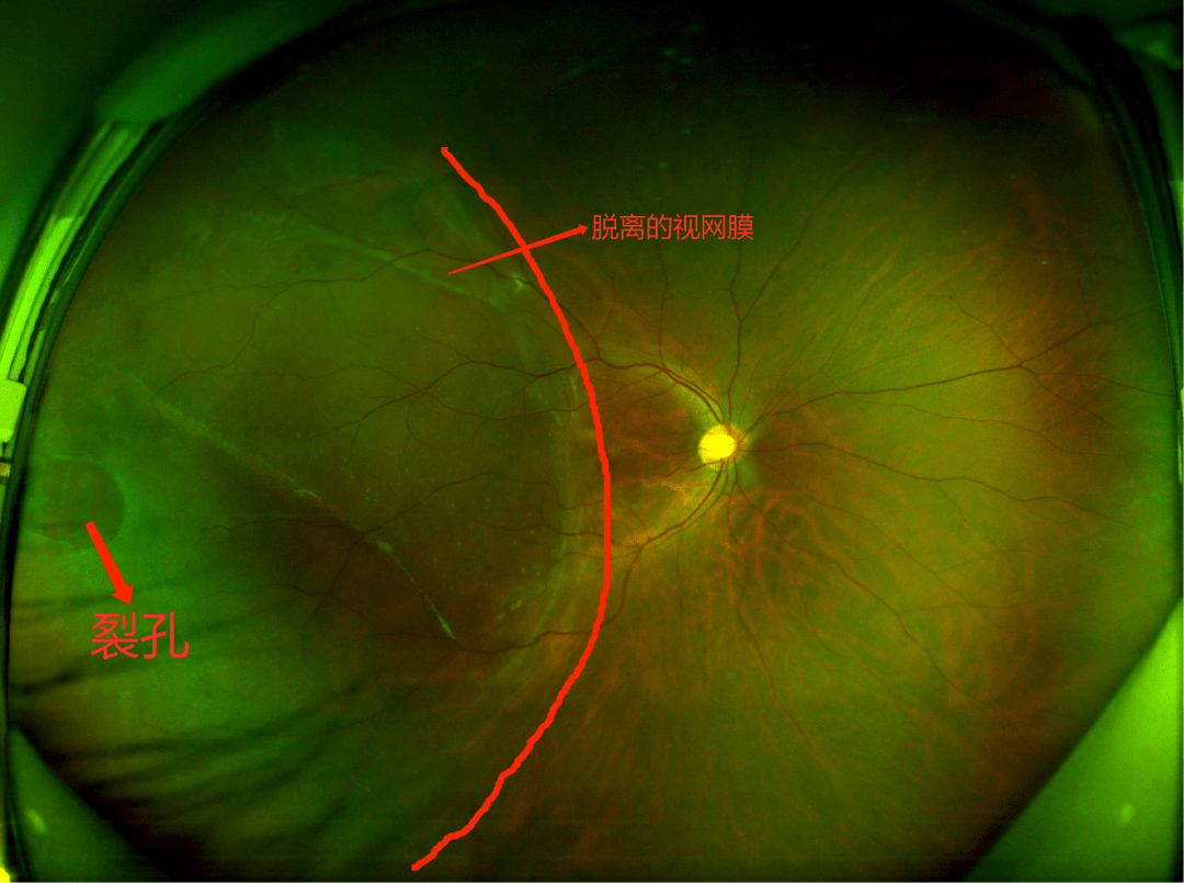 什么是孔源性视网膜脱离?