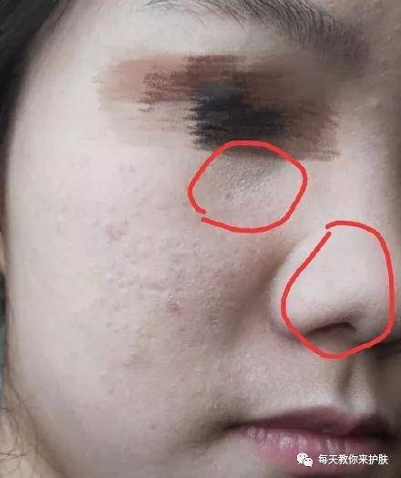 Father's|毛孔粗大，痘痘 可不止爱出油那么简单