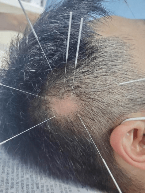 头发|?丨康复馆丨80后的头发去哪了?