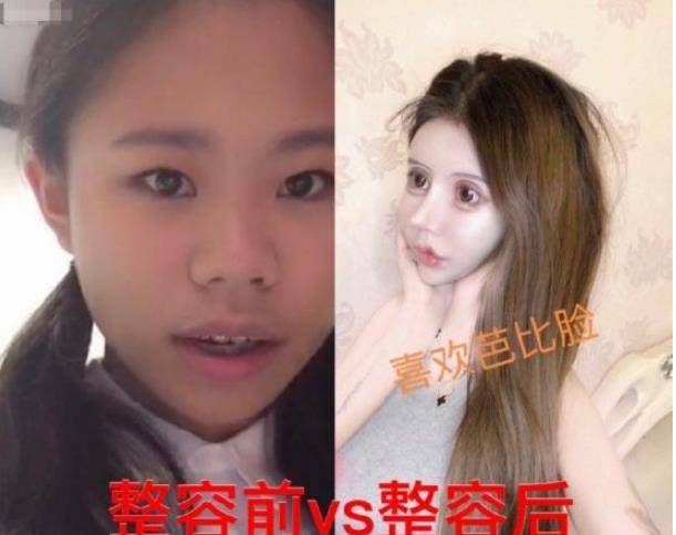 整形|还记得花百万整容的13岁女孩吗？3年整了100次，如今前后判若两人