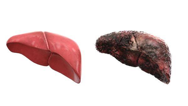 进行|肝硬化:这4种症状很明显,别当成小毛病对待!