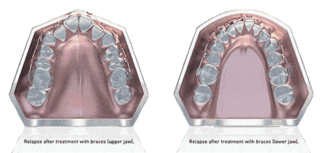 长度|何晓天医生：很多人不了解牙齿矫正中的扩弓是什么？看完这个你就知道了！