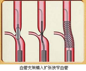 原創得了冠心病藥物治療和放置支架哪個好?放了支架還要不要再服藥?