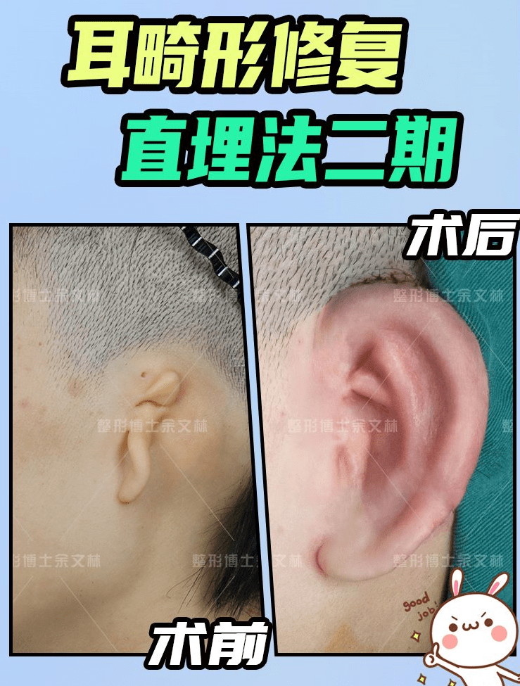 术后护理汇总 小耳畸形耳部再造手术后哪些地方需要特别注意 耳朵