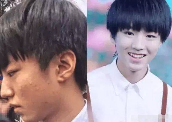 青春痘|男明星其实也会“卸妆死”，王俊凯令人大跌眼镜，最后这颜值服了