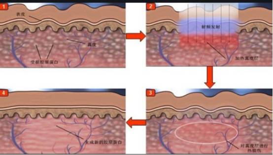 智商|孕期涂橄榄油不长妊娠纹？别交智商税了！做好这些事，远离妊娠纹