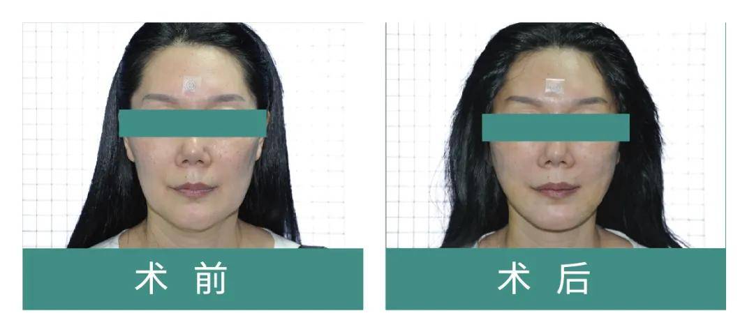 面部|法令纹太深怎么办？菲翎线提升效果好吗？