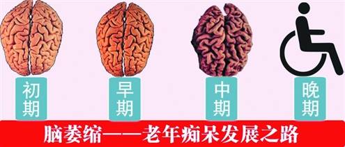 体检发现脑萎缩有的完全不需要治疗但有这类症状很严重要当心