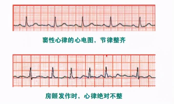 持续性|【一“心”只为您“健”康】心房颤动的诊断与分类