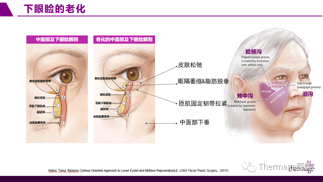 br|眶周老化丨热玛吉眼部专项抗衰第二期