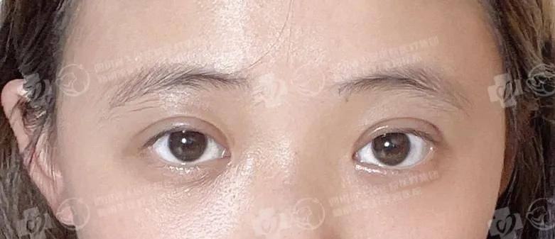 进行|“这些双眼皮贴我用不到了，你一半我姐一半”