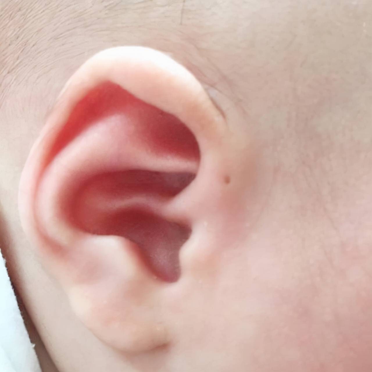 小孩耳朵有个小孔图片图片