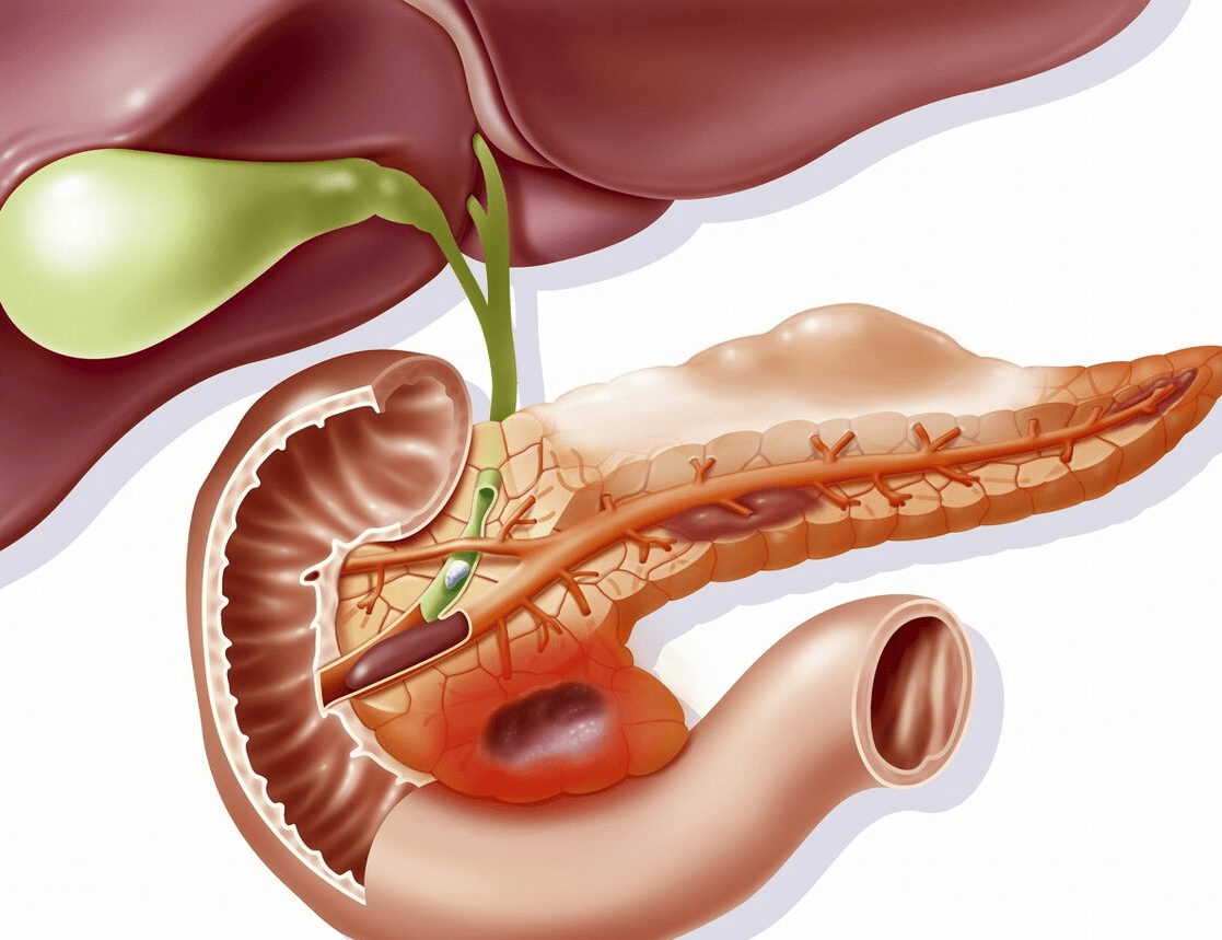 胰液|急性胰腺炎的病因有哪些？胰腺炎患者日常应该注意些什么？