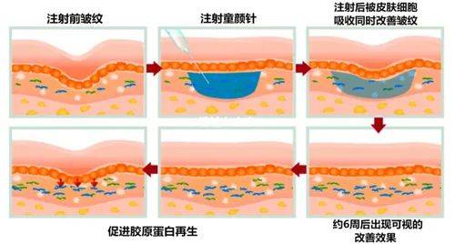 人体|500万一支？童颜针VS少女针“再生医美”深度解析