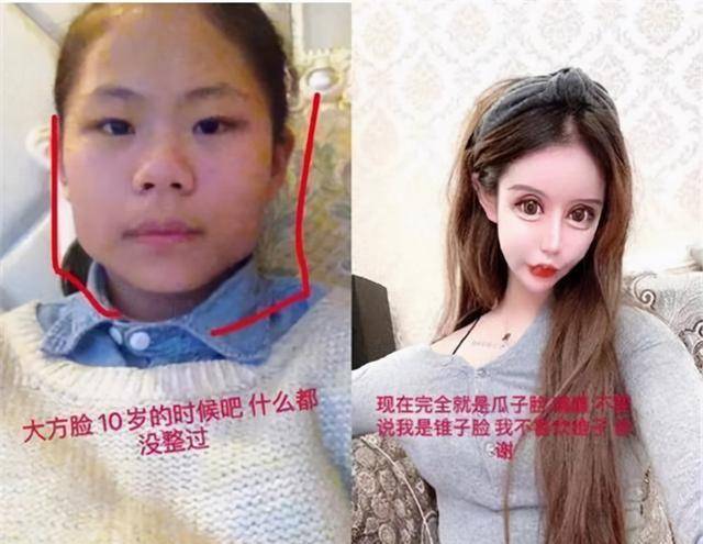 人间|13岁女孩为变漂亮,3年整容60次成小网红,自称是人间芭比