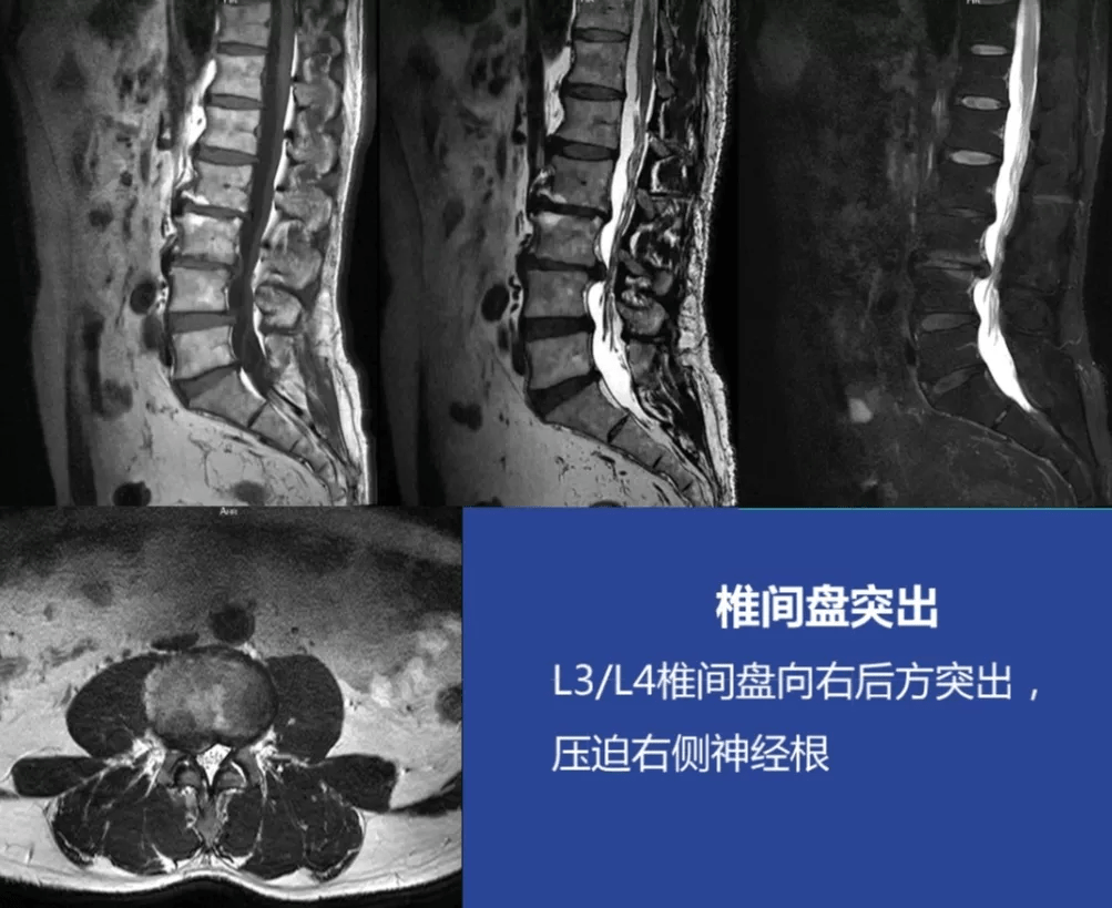 的序列中,常規掃描的序列為:矢狀位t2wi,fs t2wi,t1wi及橫斷位的t2wi