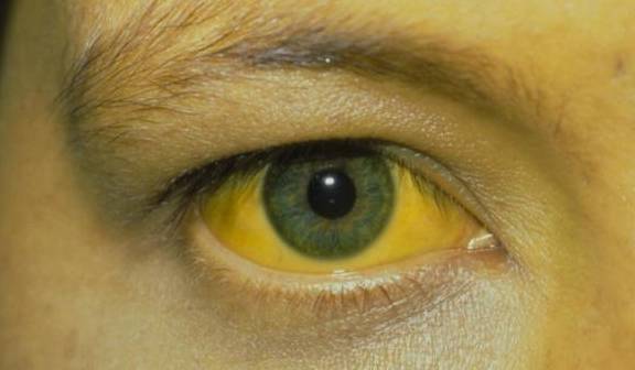 冰菊|误认为皮肤过敏，结果查出“肝硬化”，皮肤3处异常或是肝脏病变