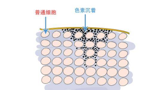 代谢|“皮肤有痘印”的女人，再缺钱也要试试这几款精华，助你告别痘印